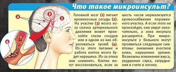 Микроинсульт - как распознать и не упустить время ... - Всё о здоровье ...