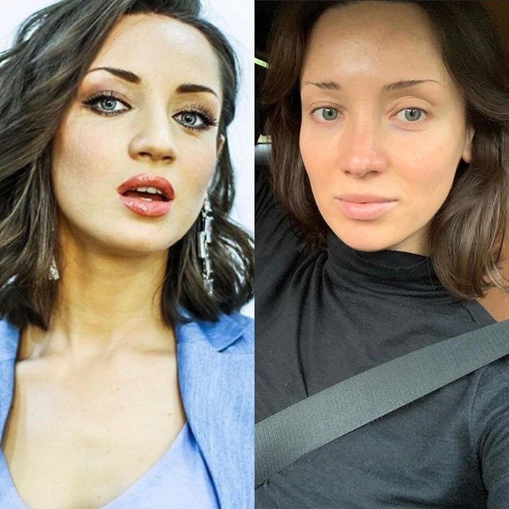 Татьяна денисова до и после пластики фото