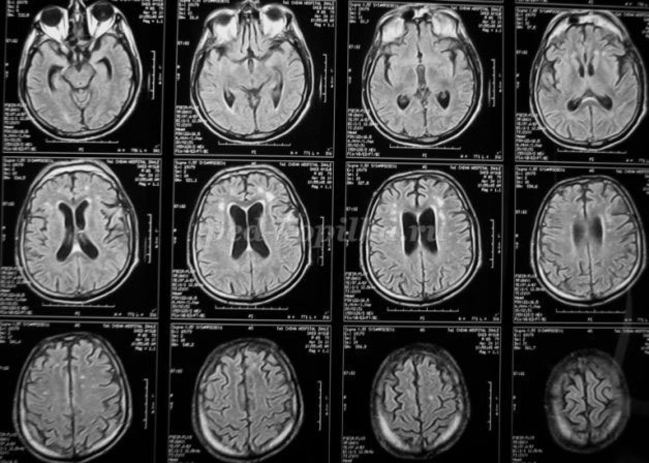 Мрт картирование головного мозга