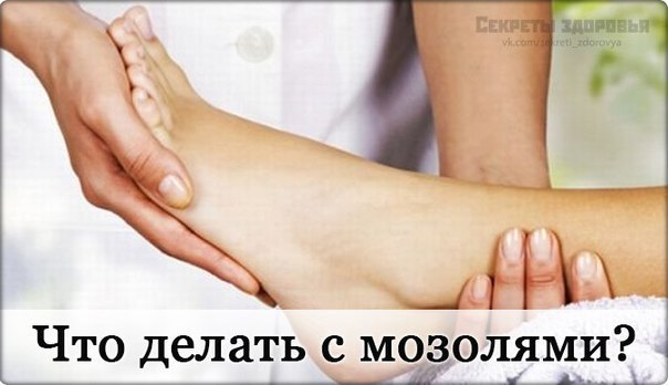 Мозоль — это местное утолщение рогового слоя кожи, возникающее вследствие неумения правильно ...