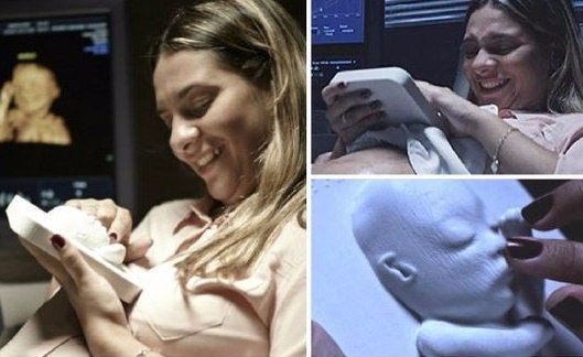 Распечатанное на 3D-принтере УЗИ помогло слепой маме увидеть своего ребенка до рождения