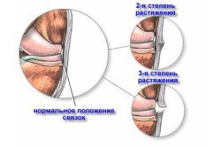 Лечение растяжения мышц спины: симптомы, причины, лечение брекетами