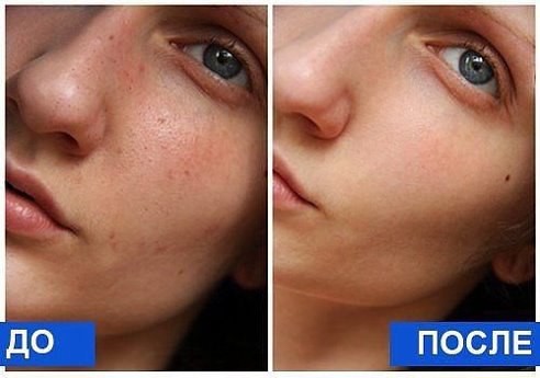 ГЛУБОКАЯ ЧИСТКА ЛИЦА ЗА 1 ПРОЦЕДУРУ.Из домашних продуктов!Такую маску попробовали все мои подруги, в ...