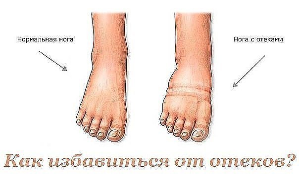 Как избавиться от отеков? В ответе на вопрос: как убрать отеки ног, лица (особенно под глазами) - ...