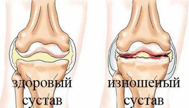 Отличный рецепт от боли в суставах.Простейший народный рецепт для лечения суставов.(не смотрите, что ...