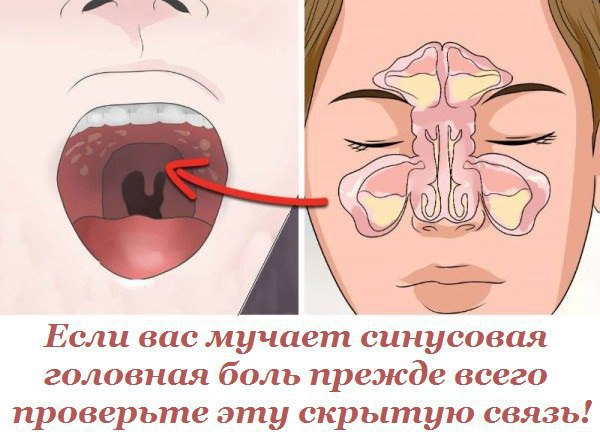 Если вас мучает синусовая головная боль прежде всего проверьте эту скрытую связь! Хотела бы я знать ...