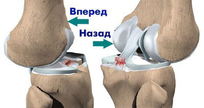 Растяжение связок колена.Растяжение связок колена возникает в тех случаях, когда одна или несколько ...