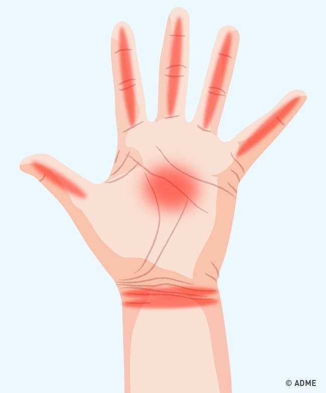 Рука колет. Парестезия большого пальца руки. Рука. Рука колет. Онемение и жжение в кисти рук.