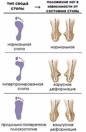 Комплекс упражнений для лечения плоскостопия.Несмотря на свою кажущуюся безобидность, плоскостопие ...