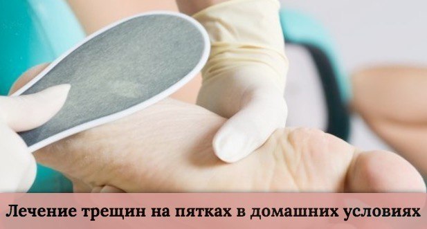 Лечение трещин на пятках в домашних условиях. Трещины на пятках вызывают дискомфорт или даже боль и ...