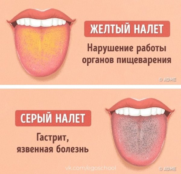Как определить заболевание по цвету языка. На заметку