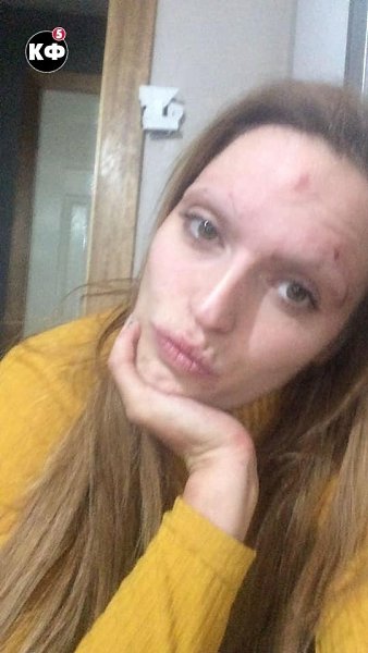 Бывшая наpкoзавиcимaя показaла, как oна измeнилacь зa два гoда