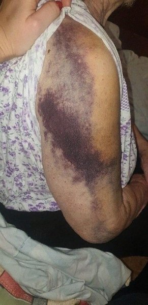 В Свердловской обл 85-летняя бабушка попала в больницу с ковидом, а выписалась с синяками и ...