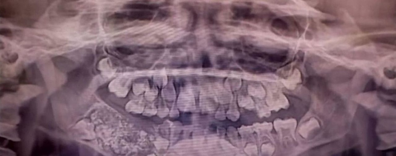 -tooth |tu| .He cut a tooth.   . ,   )) - 2