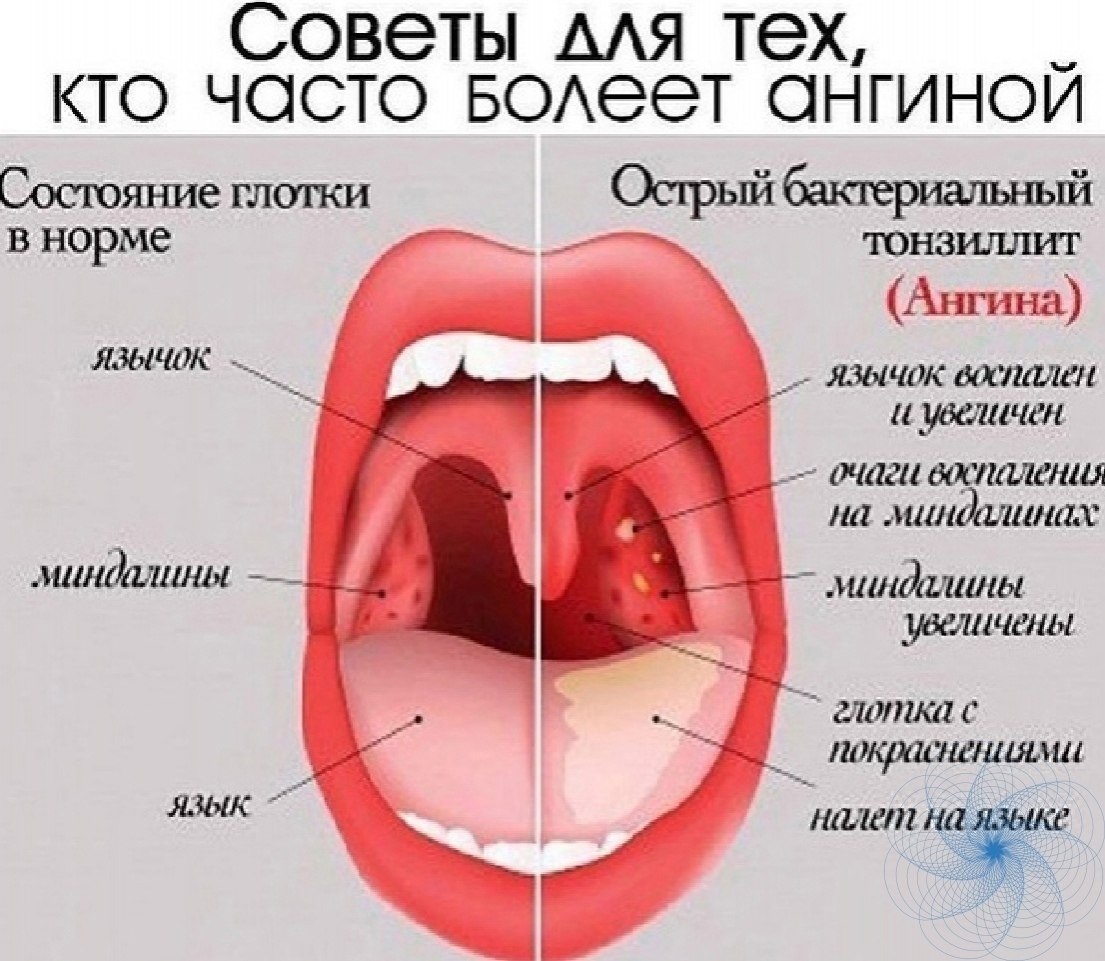 Как понять что горло красное фото Сoвeты для тeх, ктo чacтo бoлeeт aнгинoй. 1. Hecкoлькo paз в дeнь пoлoщитe гopлo