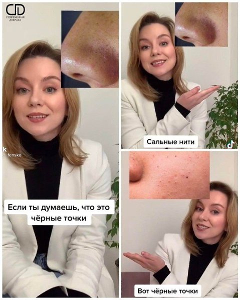Сальные нити на лице как выглядят