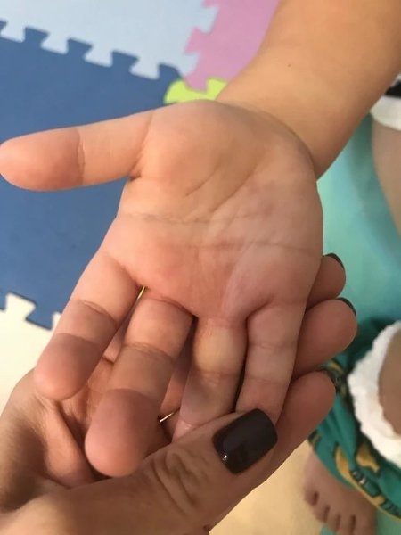 В России зафиксированы случаи заражения вирусом Коксаки среди детей. Вспышки отмечены в Московской, ... - 3