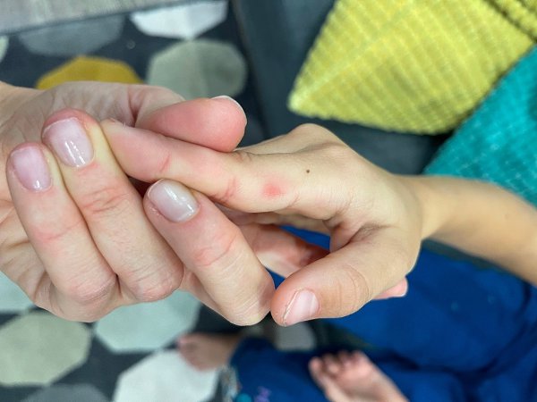 В России зафиксированы случаи заражения вирусом Коксаки среди детей. Вспышки отмечены в Московской, ...