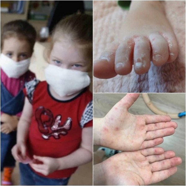 Вирус Коксаки атакует детей по всей России! В России начали фиксировать случаи заболевания вирусом ...