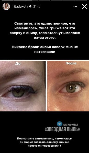 Рита Дакота сделала глаза более молодыми (что?). Вот как бывает. Подписчики волнуются, что она ... - 2