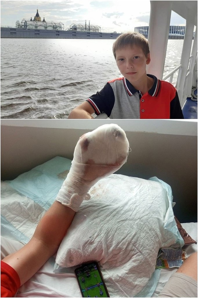 13-летний мальчик лишился пальцев после взрыва удочки. Подбросили бомбу. Во время семейного отдыха ...